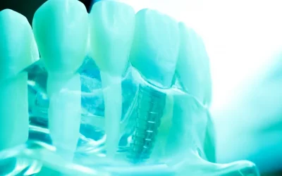 Thinking Of Having A Dental Implant?